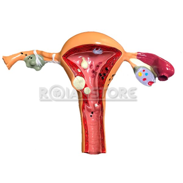 Modelo Anatomico de Ovario de Utero con patologias Con Base